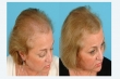 Get-the-best-Microneedling-for-Alopecia-Treatment